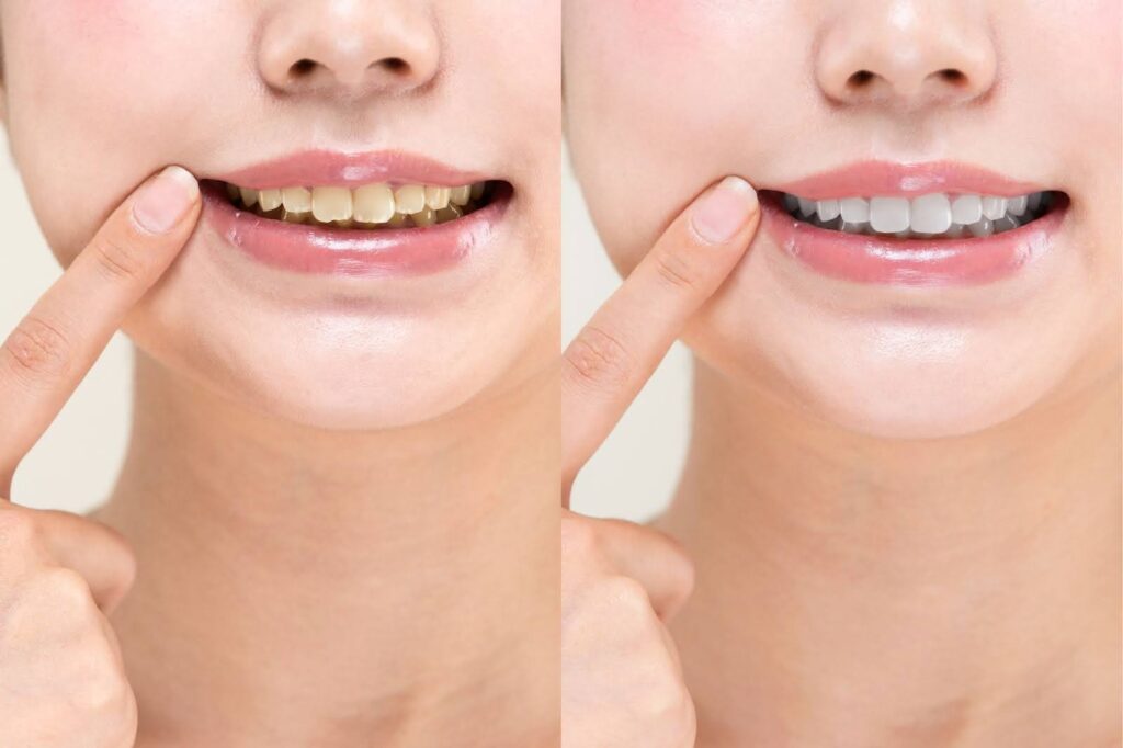 ホワイトニングとは