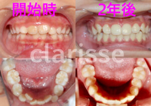 プレオルソマウスピース矯正にて歯のガチャガチャを改善