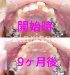 歯の叢生をインビザラインマウスピース矯正にて歯列矯正