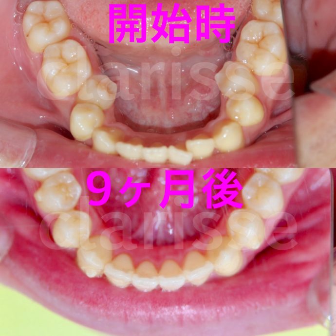 奥歯から動かす矯正はインビザラインマウスピース矯正
