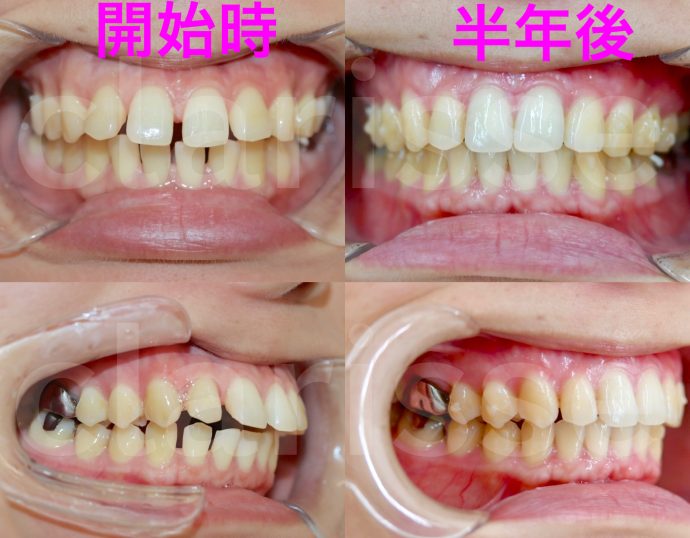すきっ歯の全体矯正もインビザラインマウスピース矯正