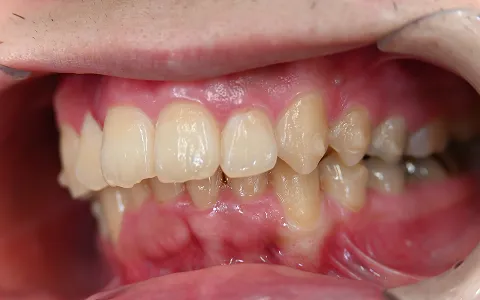 出っ歯（上顎前突）の治療後