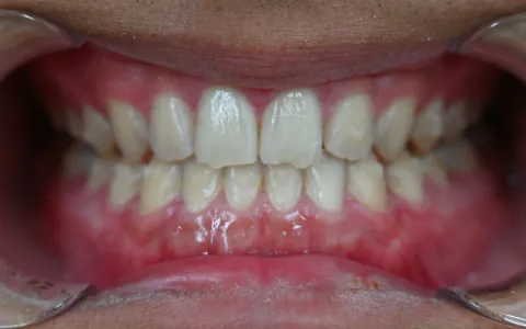 すきっ歯（空隙歯列）の治療後