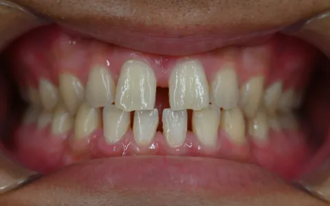 すきっ歯（空隙歯列）の治療前