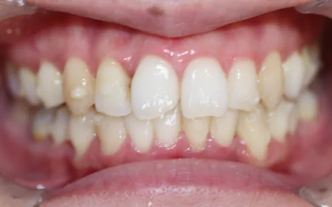 叢生（そうせい）の治療後