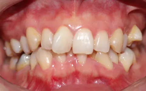 叢生（そうせい）の治療前