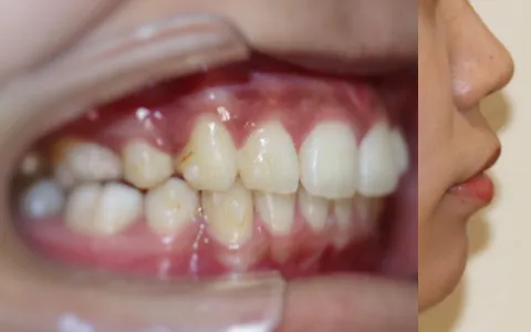 口ゴボ（上下顎前突）の治療後