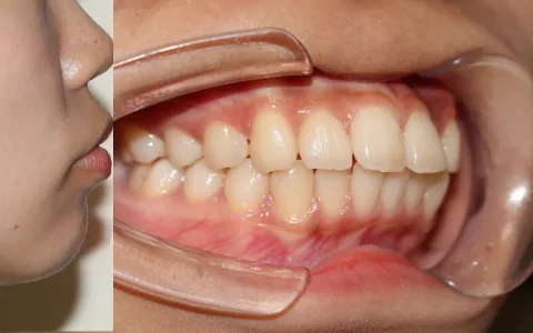 口ゴボ（上下顎前突）の治療前