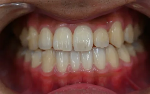 受け口（下顎前突）の治療後