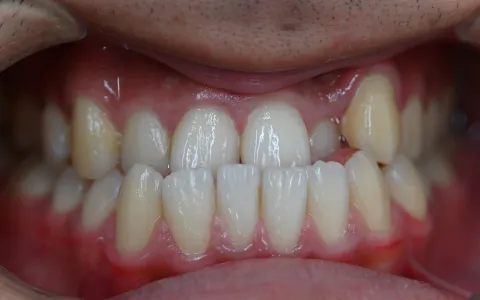 受け口（下顎前突）の治療前