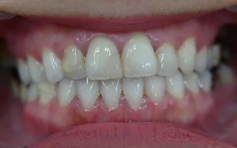 交叉咬合（こうさこうごう）の治療後