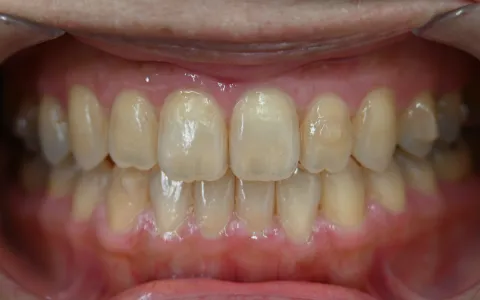 開咬（オープンバイト）の治療後