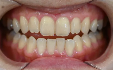 開咬（オープンバイト）の治療前
