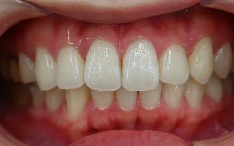 過蓋咬合（ディープバイト）の治療後