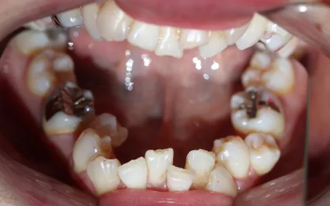 初診時の口腔内