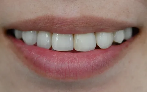 施術後の口腔内