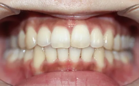 施術後の口腔内