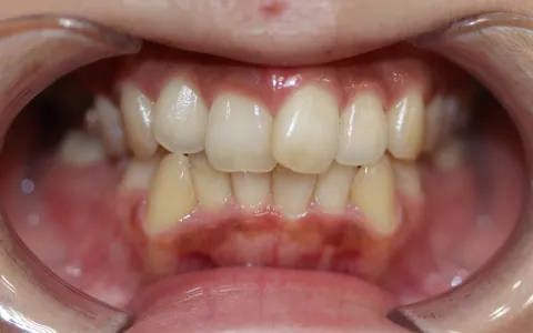 初診時の口腔内