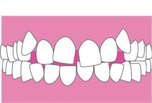 <p>叢生（ガタガタの歯並び）</p>
