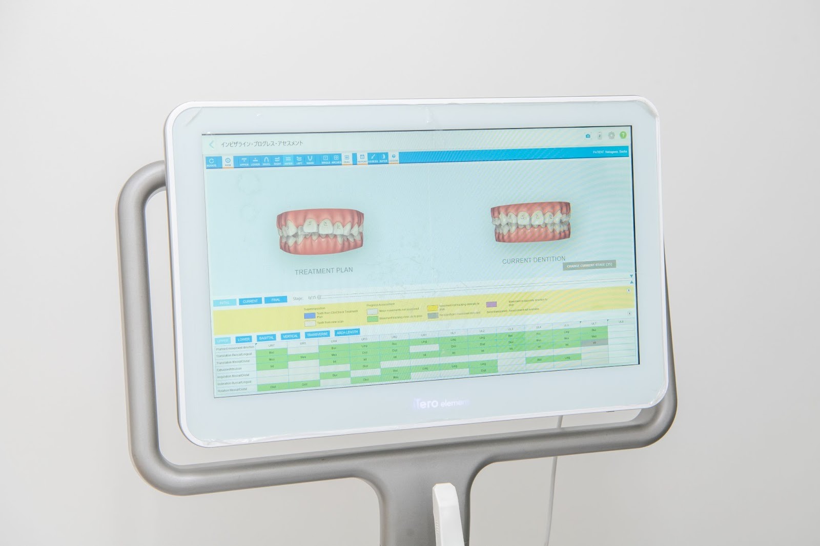 クリンチェック（3Dシミュレーション）