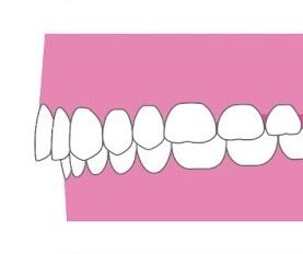 <p>出っ歯（上顎前突）</p>
