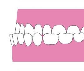 <p>受け口（反対咬合）</p>
