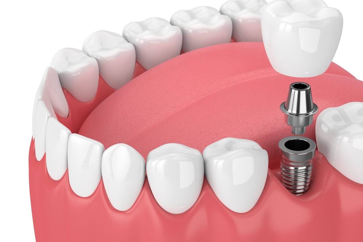 人工歯（上部構造）装着