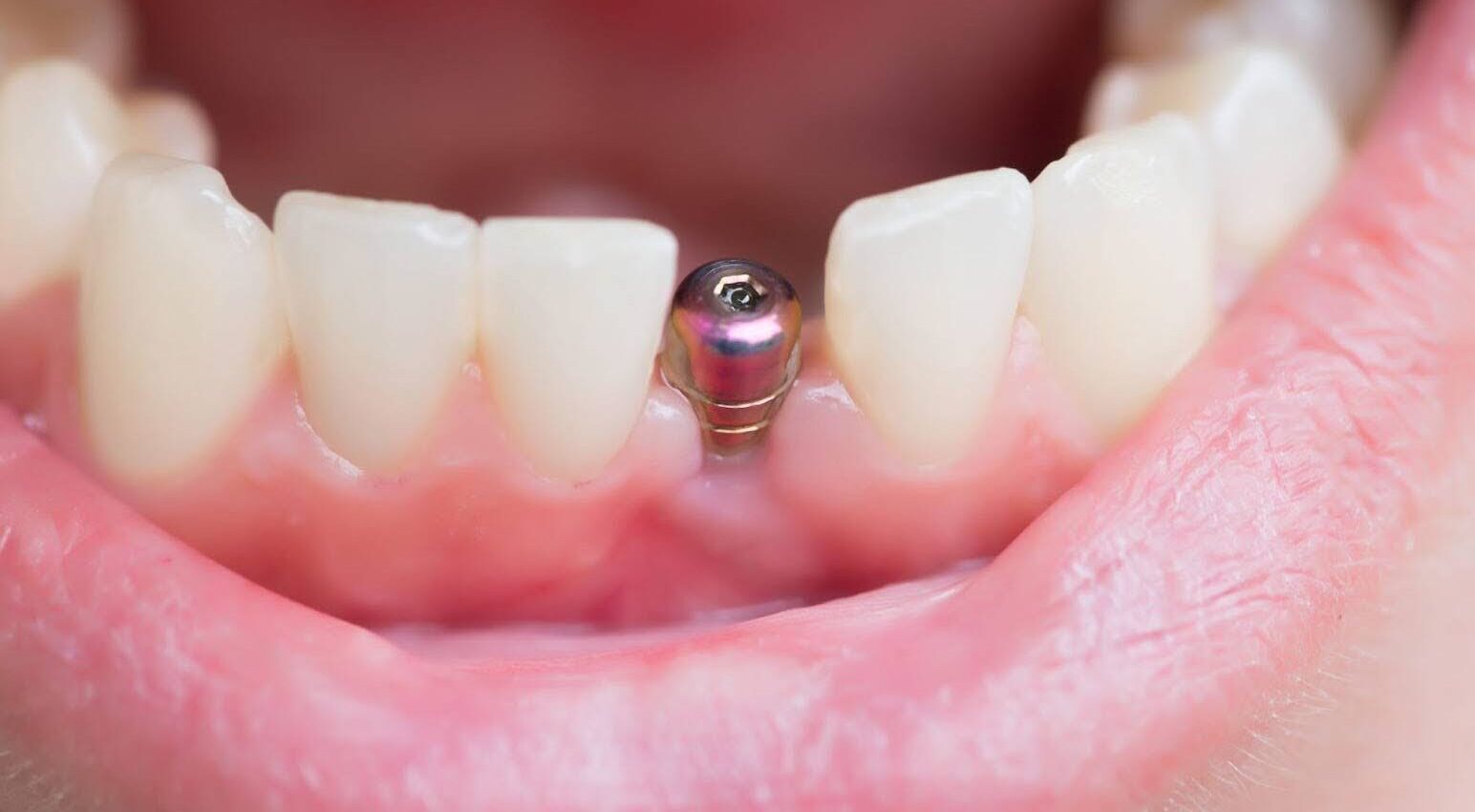 二次手術・アバットメント装着