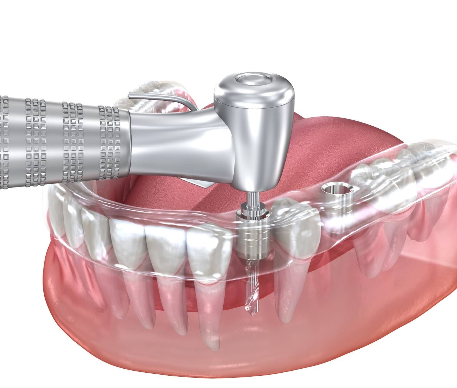 <p>ガイドシステムを利用した、精密かつ安全なインプラント治療</p>
